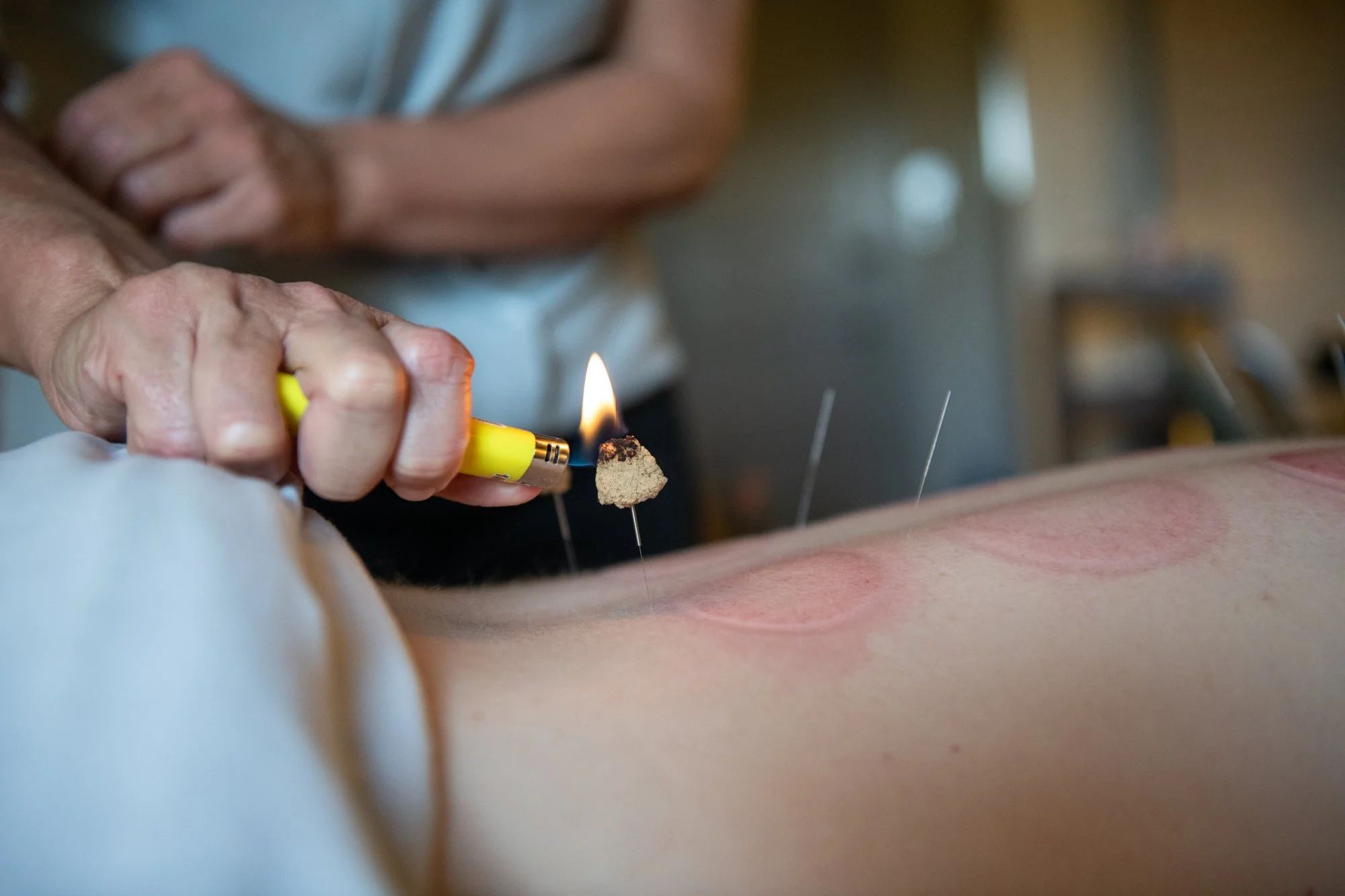 julie-acupuncture-58.jpg