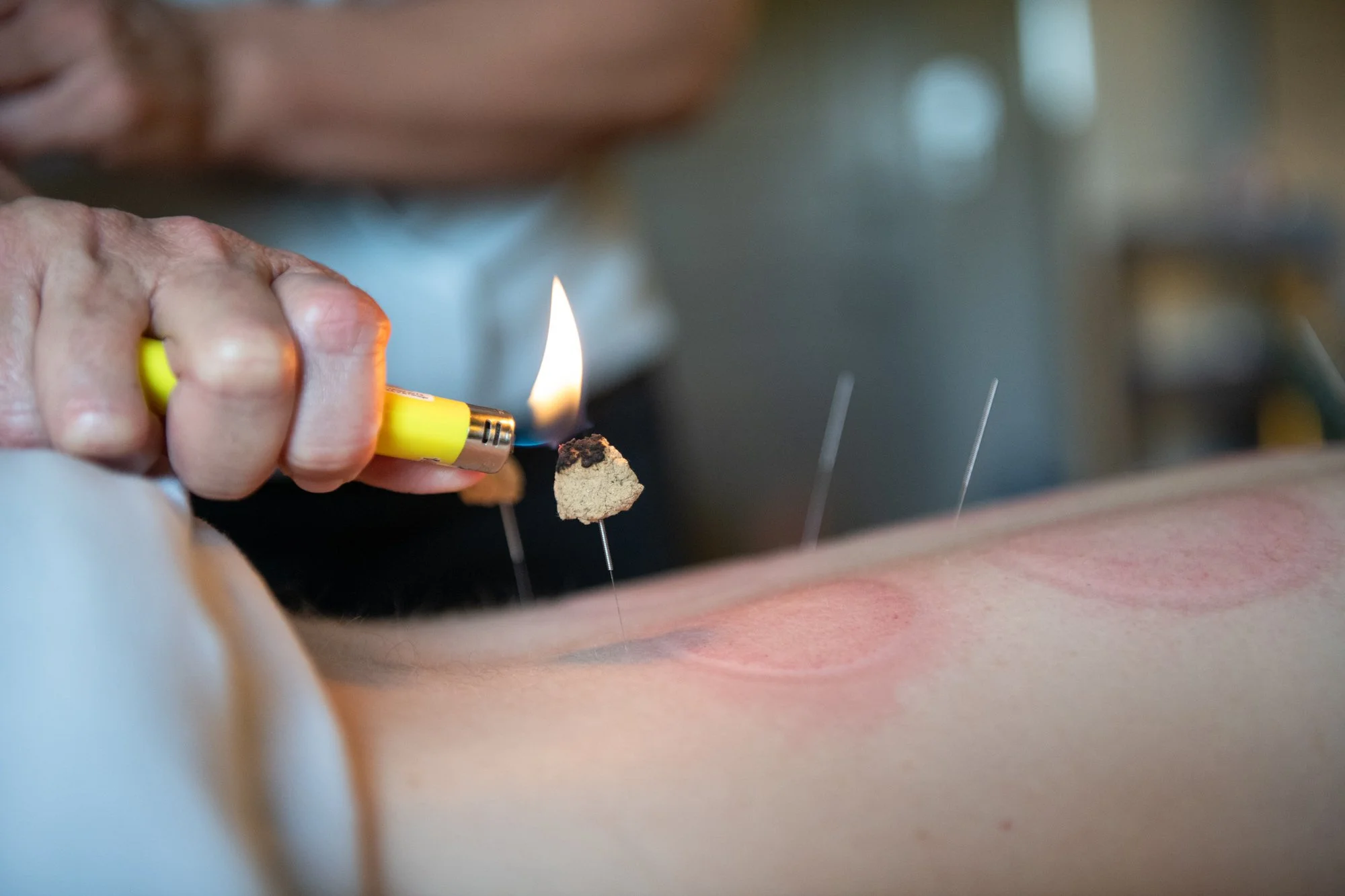 julie-acupuncture-59.jpg