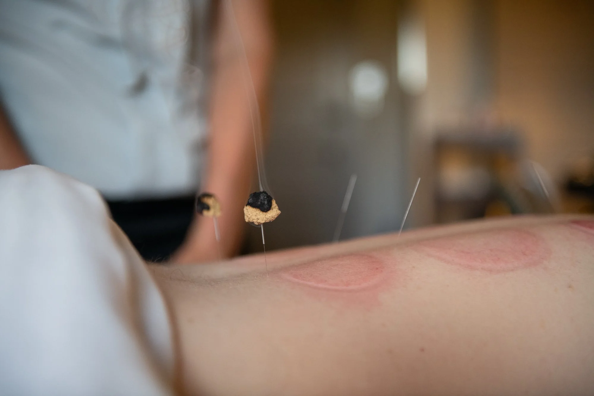 julie-acupuncture-61.jpg