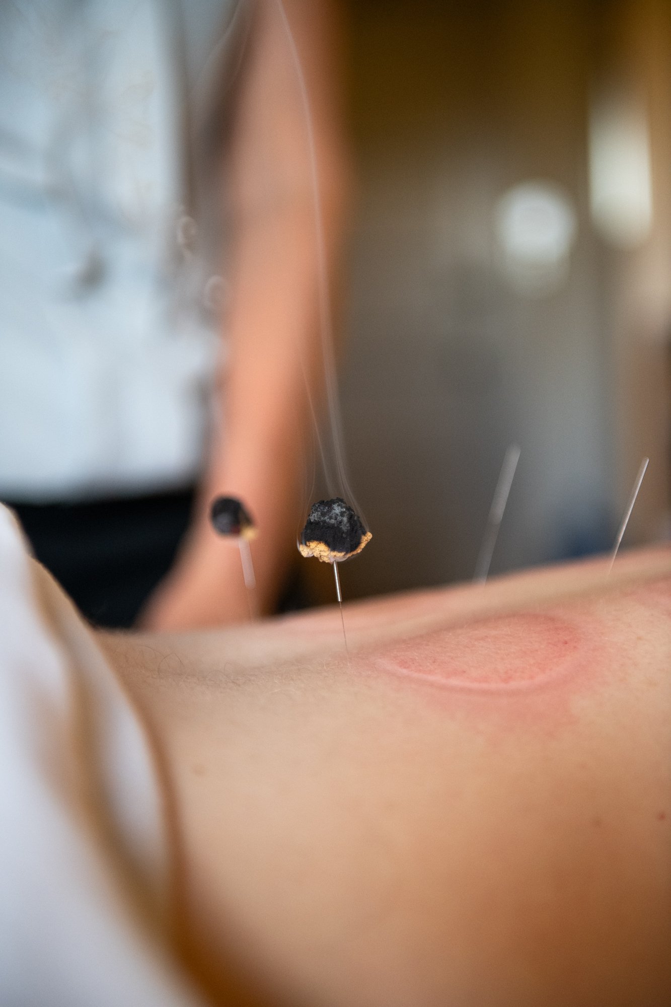 julie-acupuncture-65.jpg