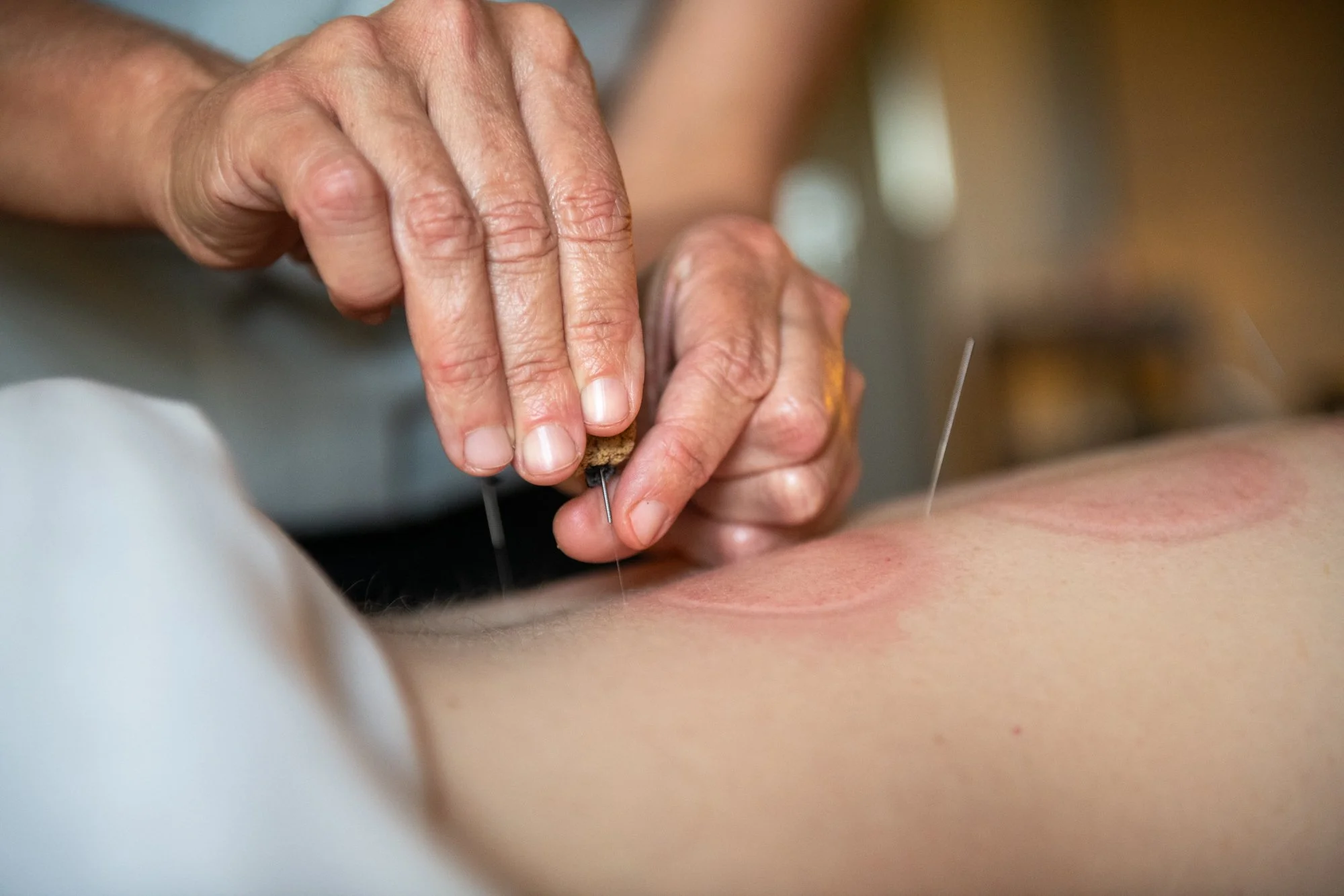 julie-acupuncture-67.jpg