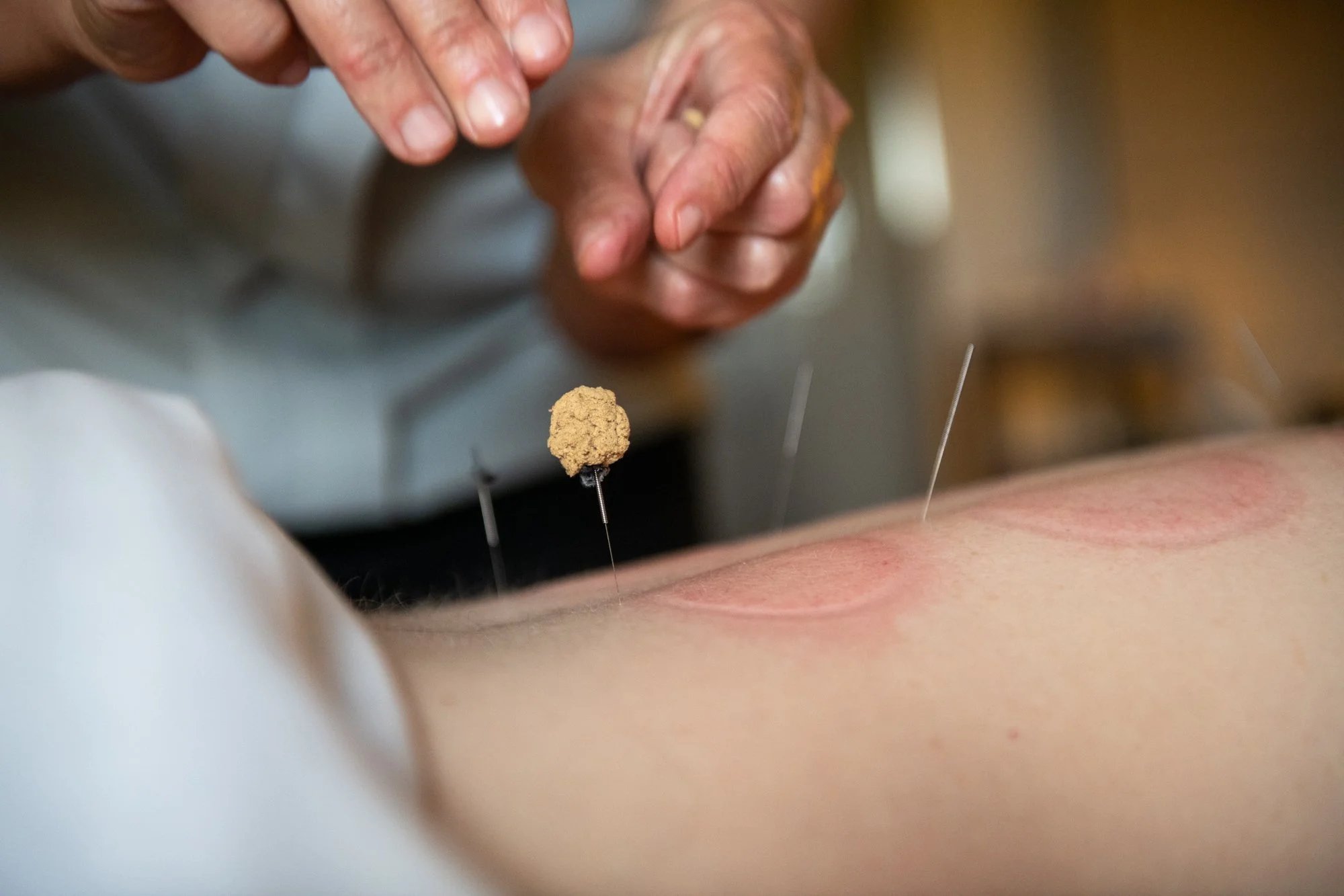julie-acupuncture-68.jpg