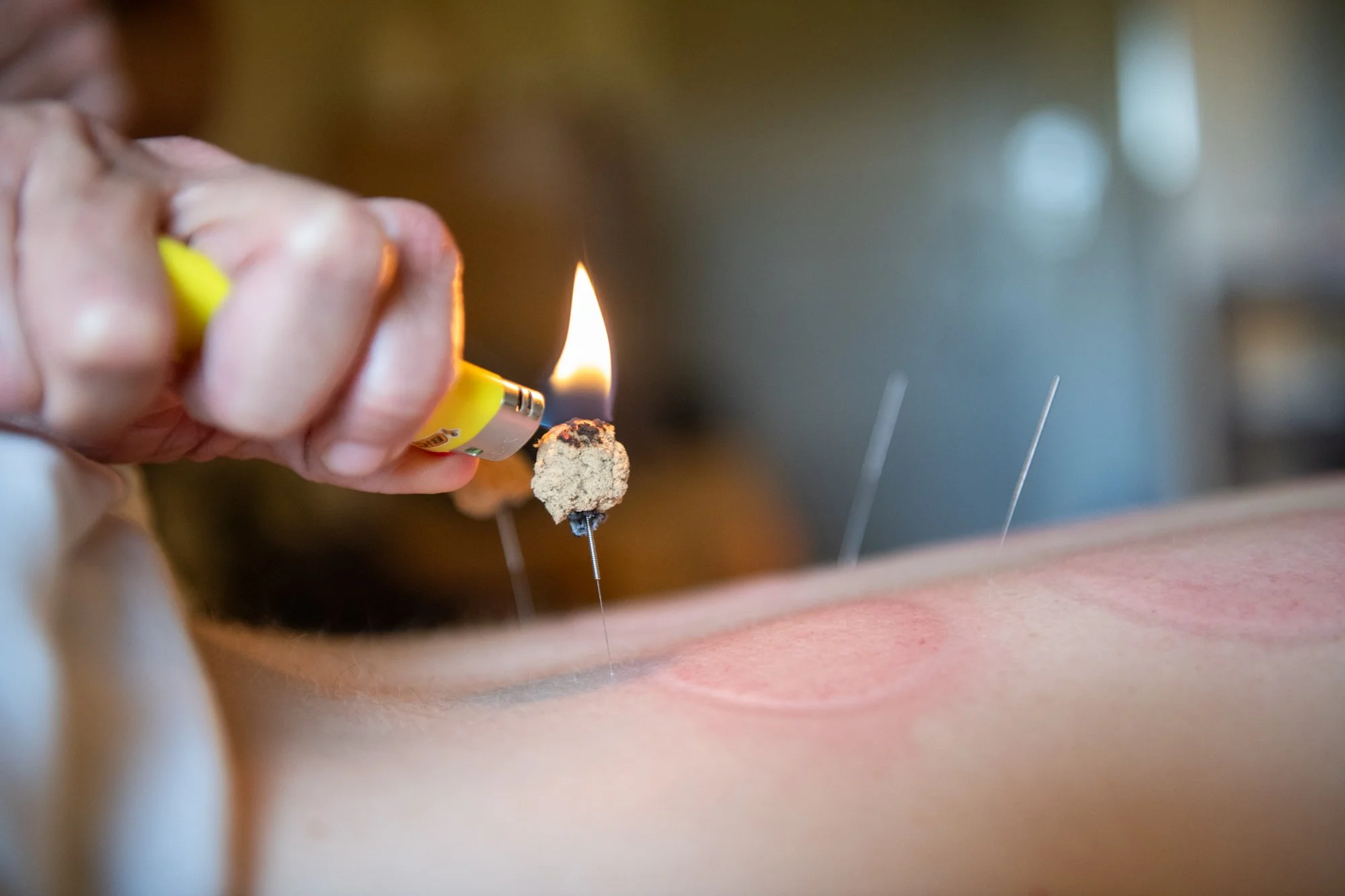 julie-acupuncture-70.jpg