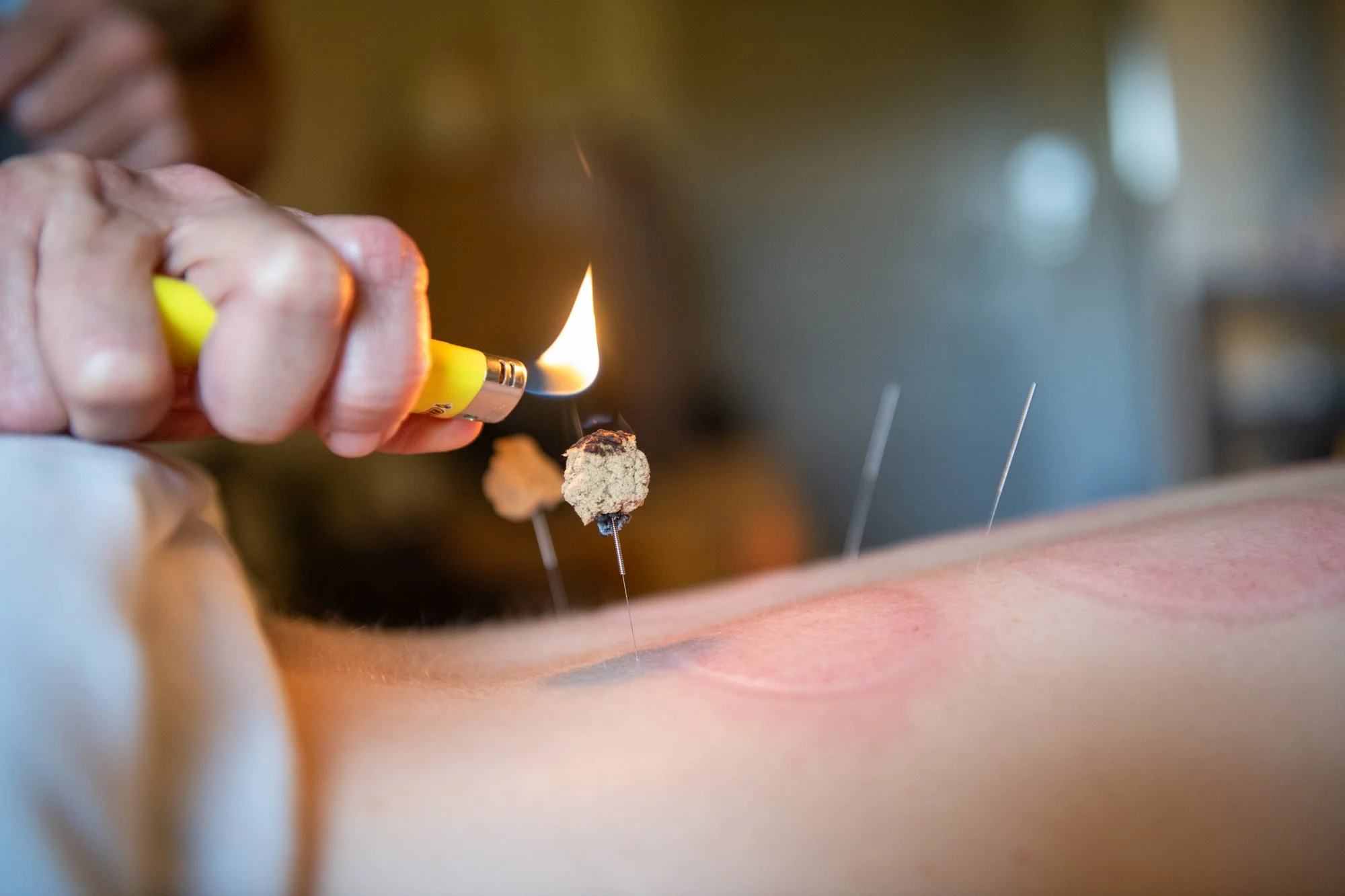 julie-acupuncture-71.jpg