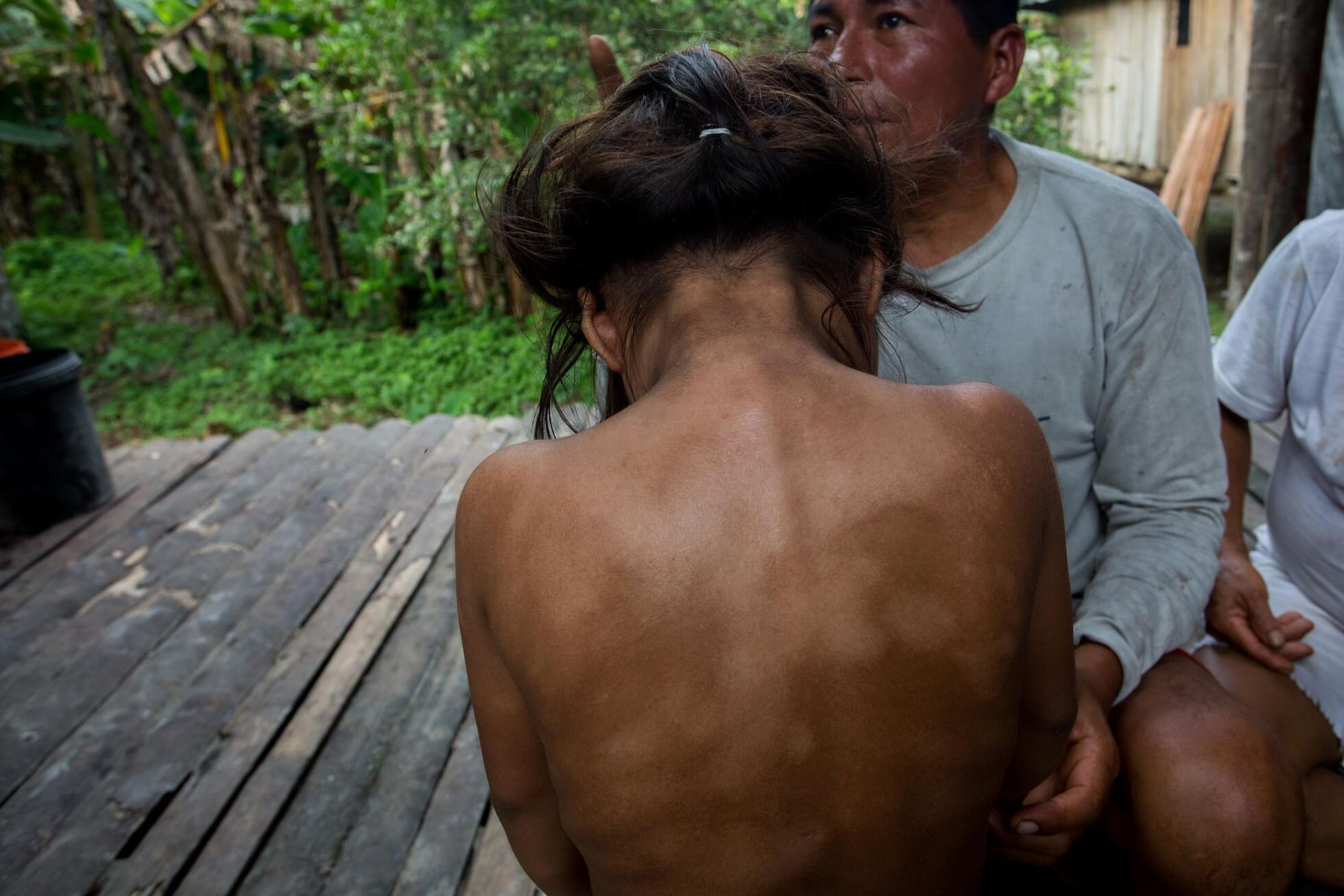 In the Sani Isla commune in the Orellana province, Damary Mayerli Grefa shows the skin problems that were caused by contact with water contaminated by the oil.IVAN CASTANEIRA / AGENCIA TEGANTAI