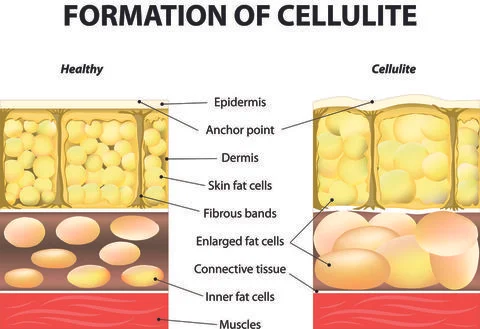 formation of cellulite.jpg