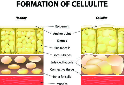 formation of cellulite.jpg