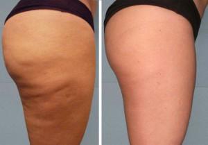 Cellulite before and after treating the area