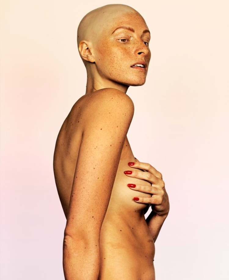 A turning point in my hair loss, when my career helped me find confidence and acceptance.