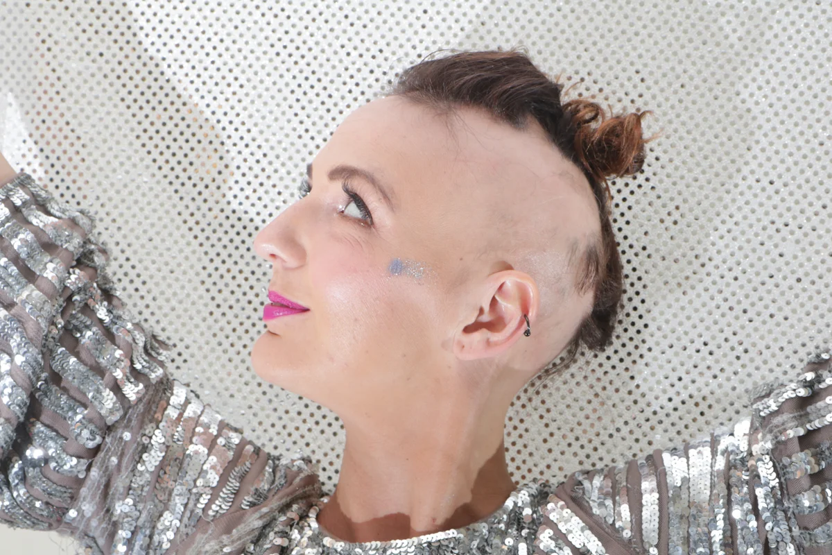 Lady Alopecia (aka Emma)’s story