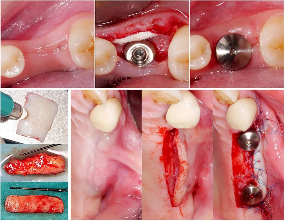 Weichgewebsmanagement an Implantaten - Ästhetik, Korrekturen & Prävention