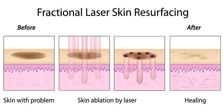 Laser skin resurfacing: Uses, benefits, risks, and cost