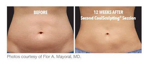 coolsculpt results.jpg