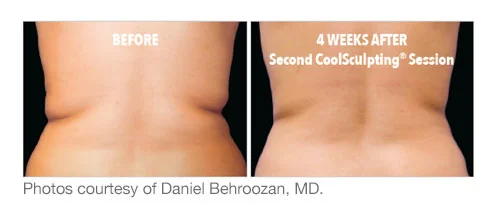 coolsculpt results2.jpg