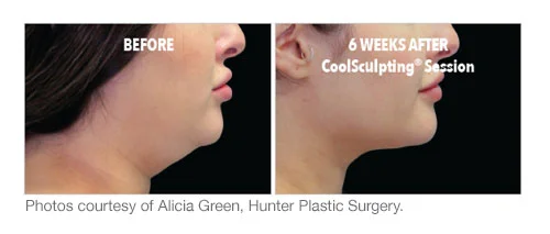 coolsculpt results3.jpg