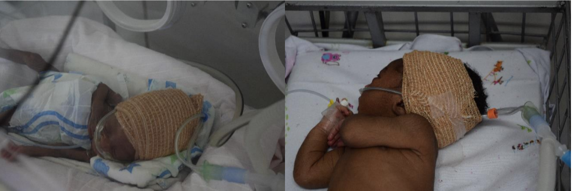 Tubes are wrapped around infant's’ head with gauze due to lack of proper medical equipment
