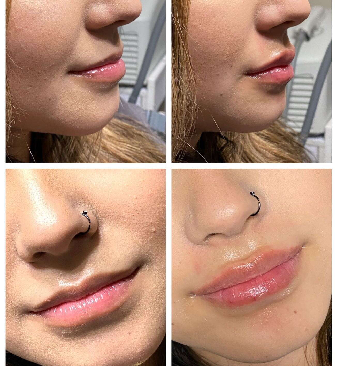 Gorgeous lip filler enhancement! #versalips #in2itionnp #lipfiller #beautyvaultmansfield #mansfieldmedspa