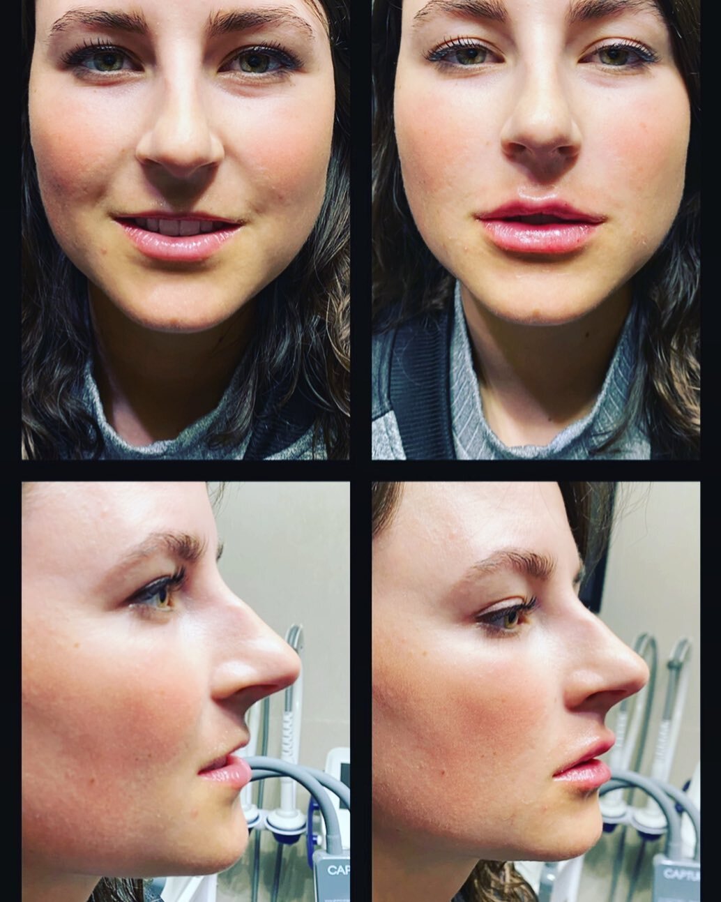 Just a little here and a little there 💉💋
#lipfiller #mansfieldmedspa #versalips #beautyvault #mansfieldlipfiller