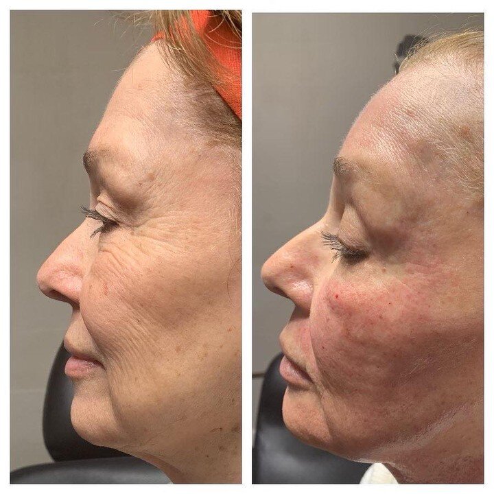 🔹Morpheus8🔹
-This is a microneedling device that uses radio frequency energy to contour the face &amp; body
-Morpheus8 resurfacing technology targets deeper layers of the skin, giving it a more lifted appearance 
-We recommend a total of 3 treatmen