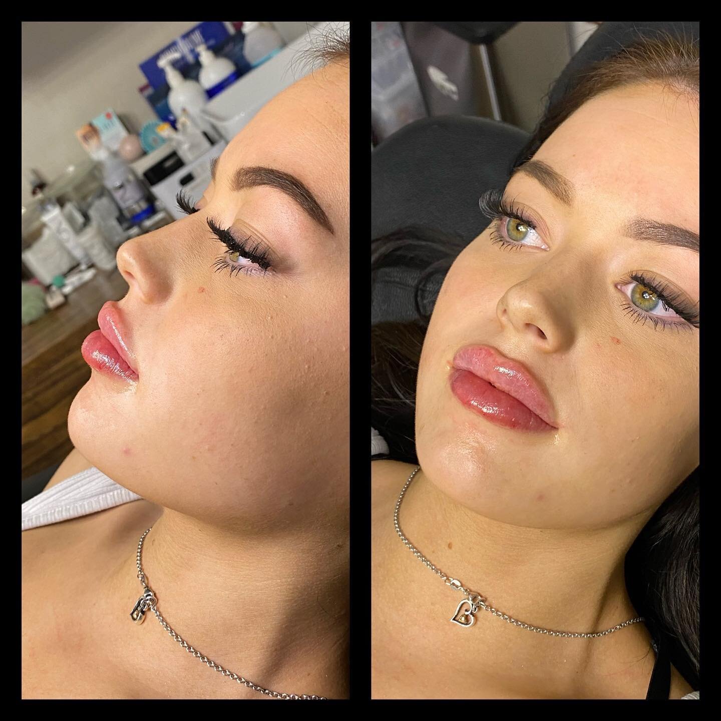 Gorgeous lip 💋 enhancement with @revanesseusa Versa! 
📝pictures taken immediately following injections. Swelling will subside in 1-2 weeks. 
#versa #lipfiller #lipenhancement #mansfieldbotox #mansfieldtx #mansfieldmedspa #mansfieldlipfiller