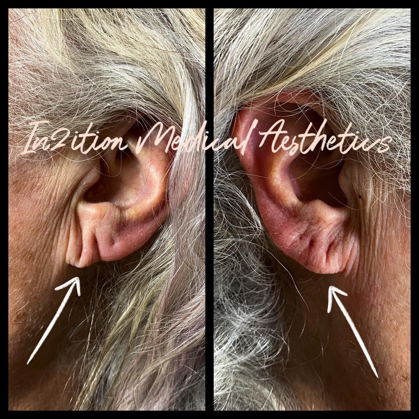 Let&rsquo;s talk 🗣about ear👂🏻injections 💉❗️
Aging and years of wearing those beautiful heavy earrings we all love😍 can result in saggy earlobes! 
Did you know?&hellip;..🤔
Filler injections in the earlobe will restore that lost volume and suppor