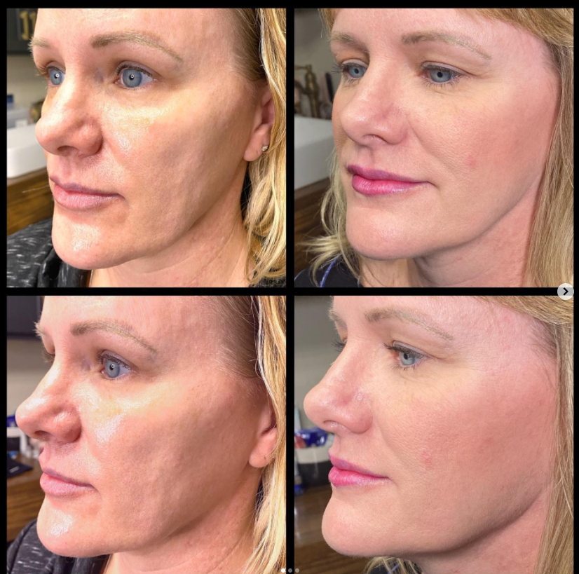 Pdo Thread Lift — In2ition Medical Aesthetics Mansfield Tx