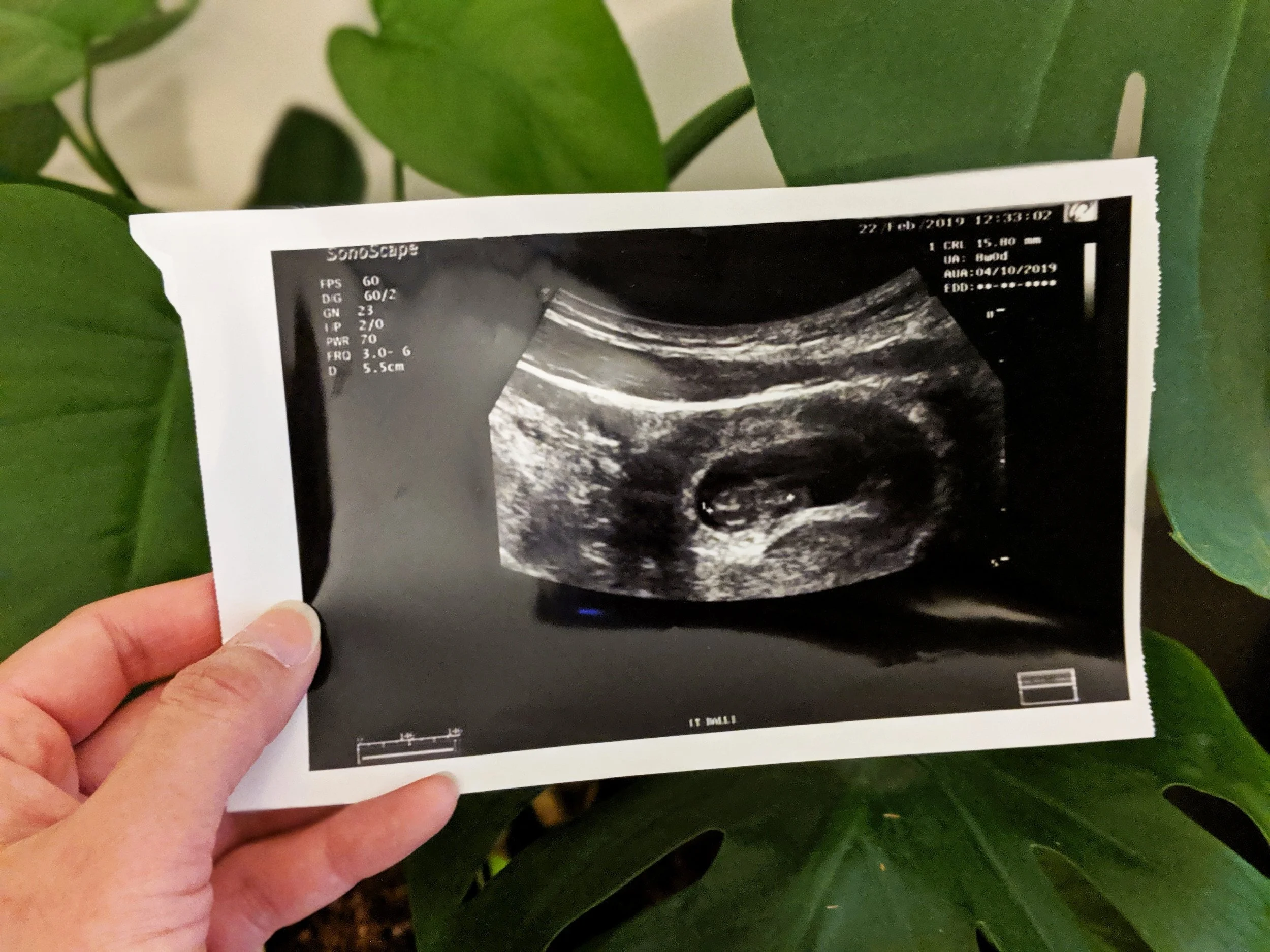 Pregnancy story: The first trimester