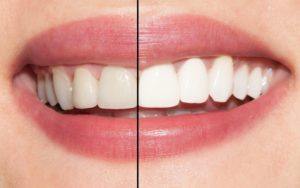 Teeth.jpeg
