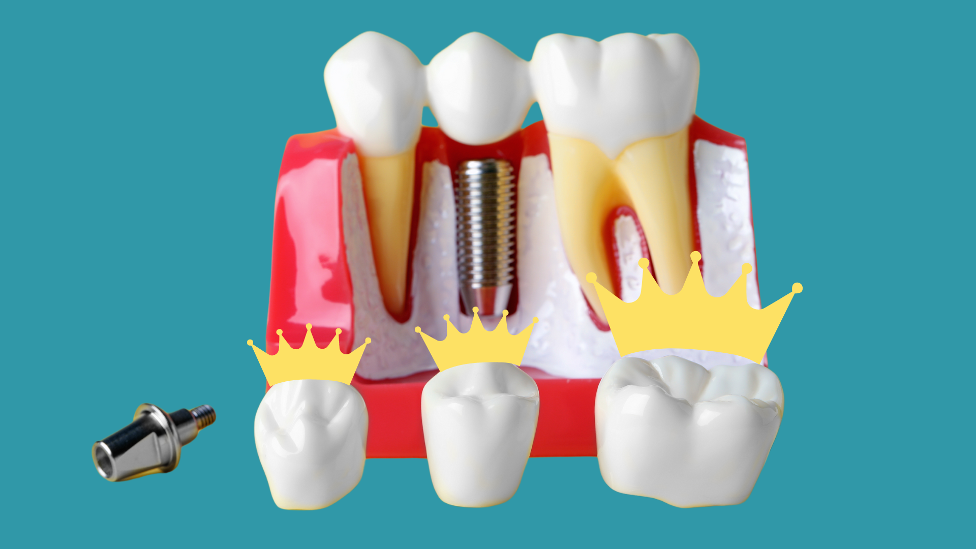 Crowns Fit for Royalty