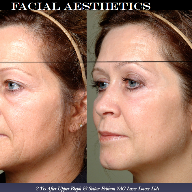 More on laser Blephs