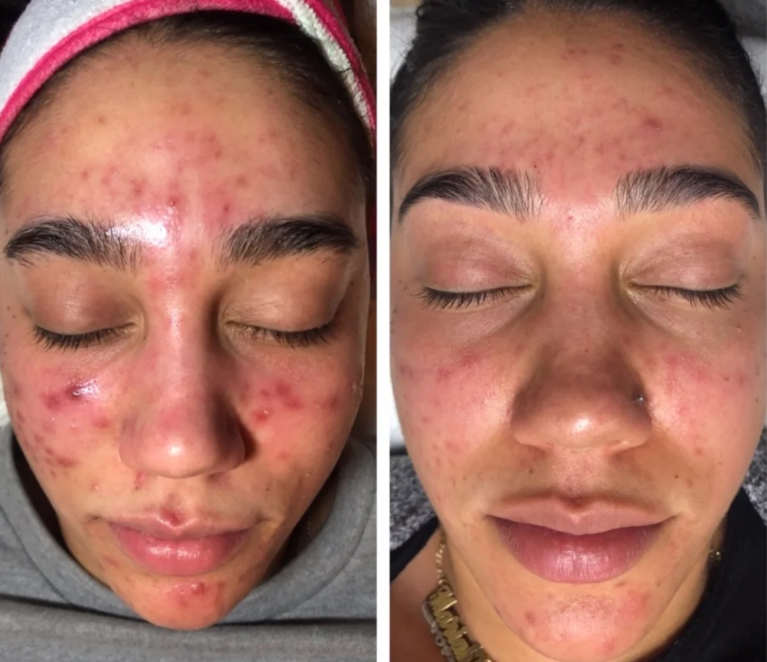 Chemical Peel