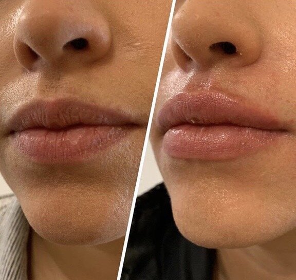 Lip Filler