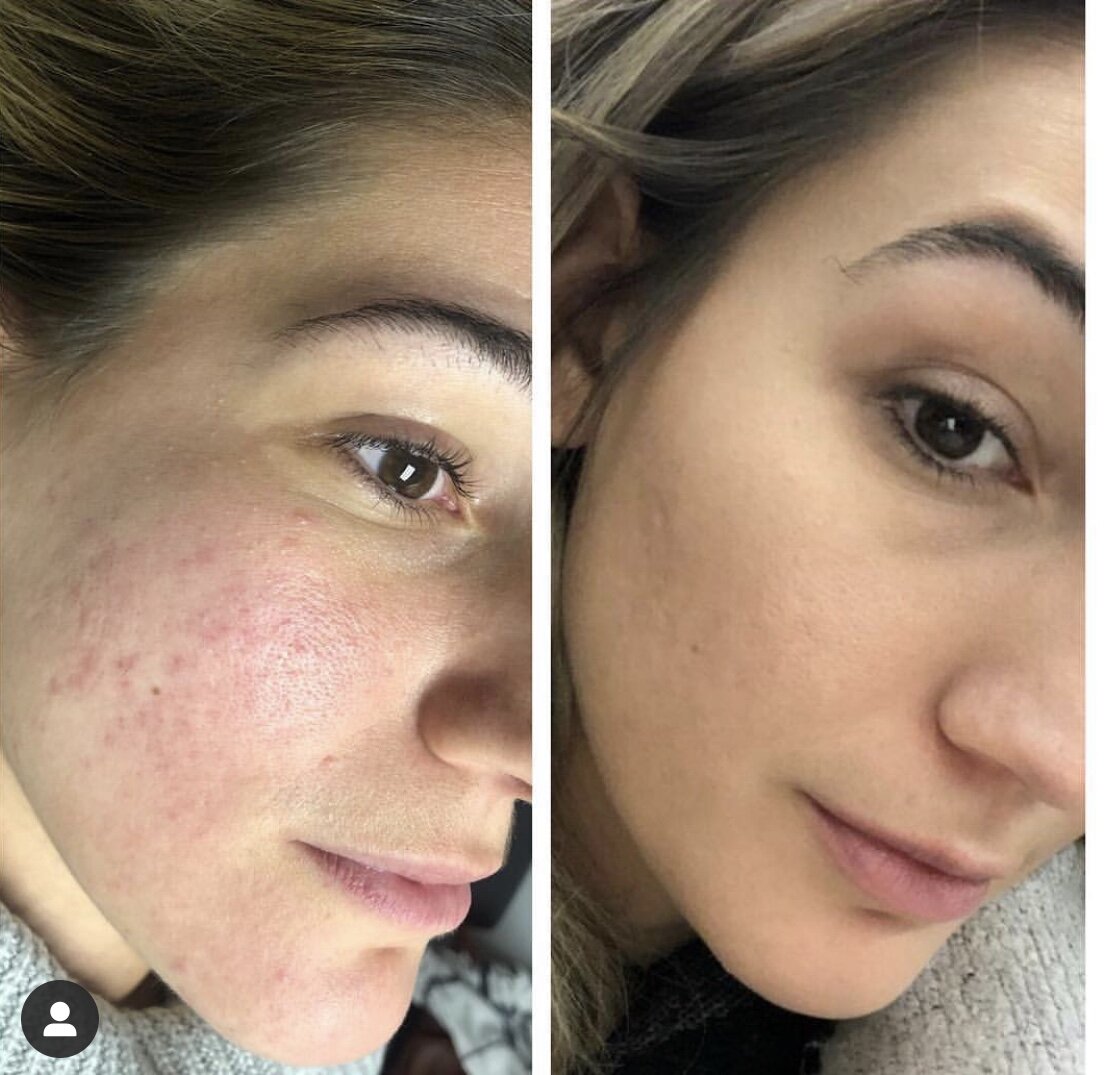 Microneedling