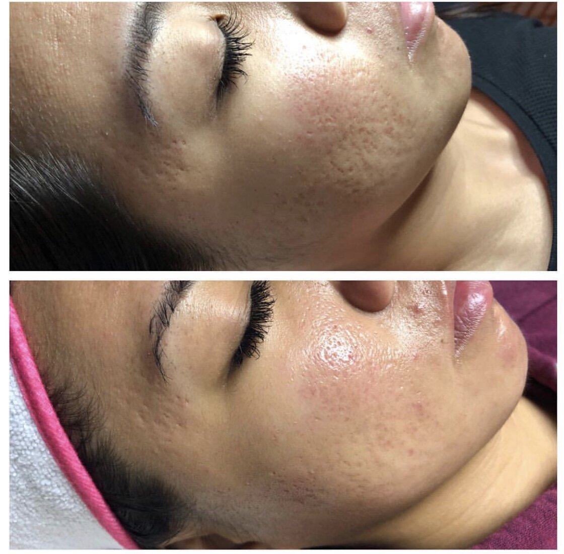 Microneedling