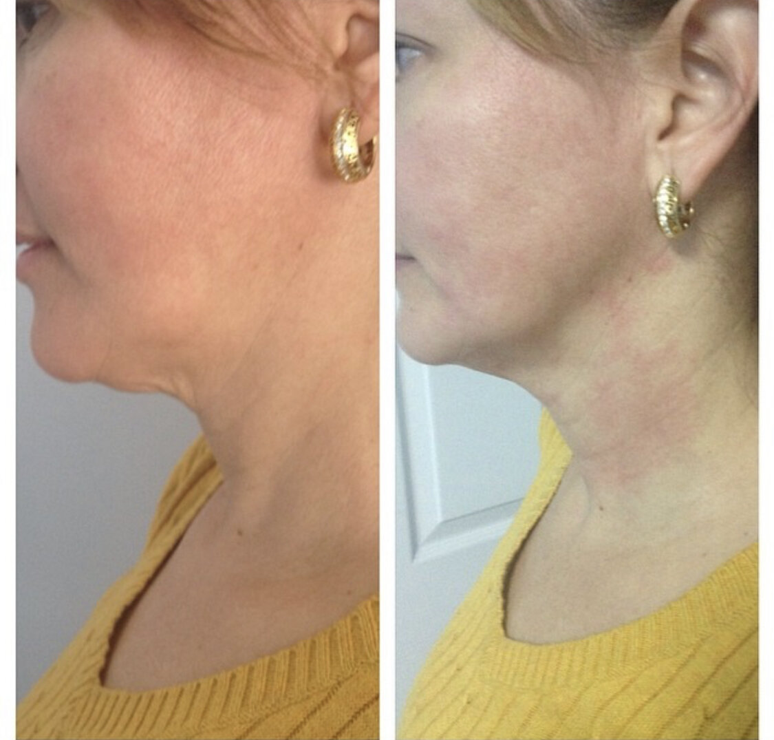 Titan Skin Tightening