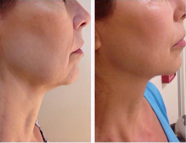 RF Skin Tightening