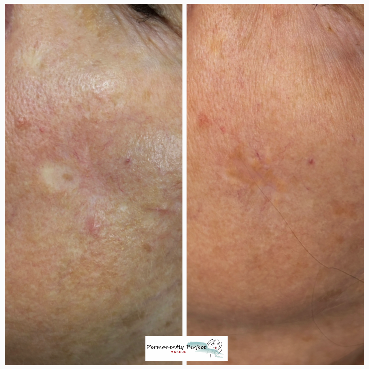 Acne scar camouflaging before and after pics from just one session.