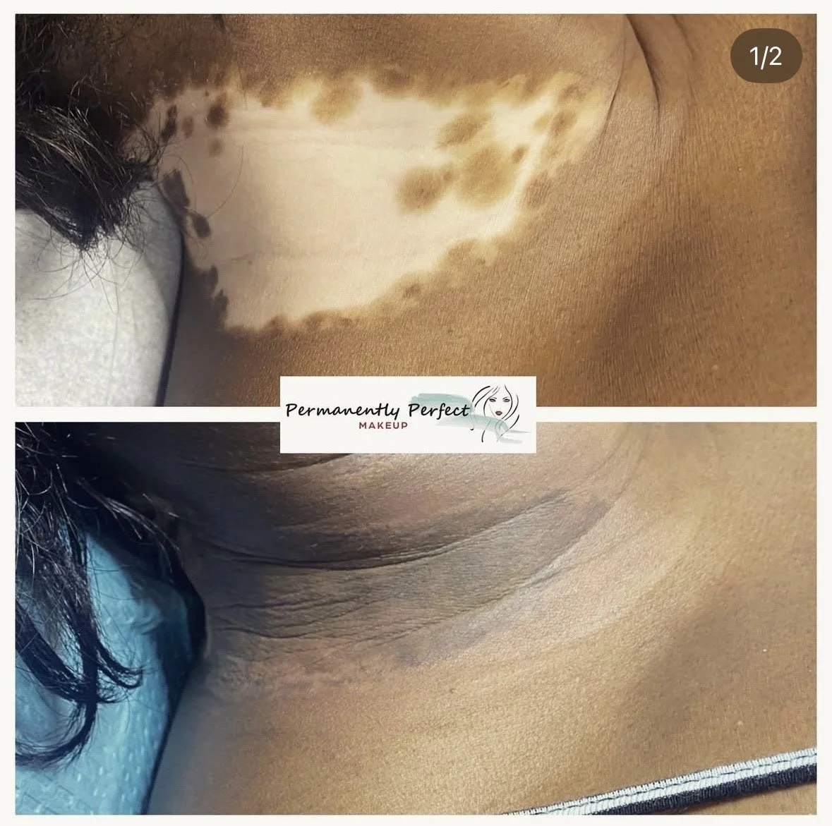 Vitiligo camouflaging before and immediately after