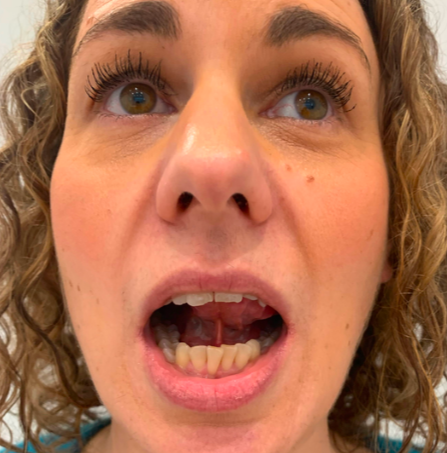 How Do I Know if Tongue Tie Is Affecting My Singing Voice? (Signs Singers Should Look For)
