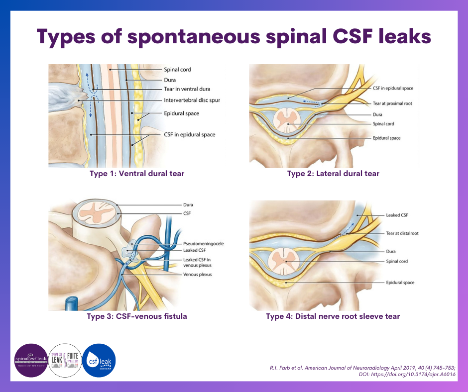 What is a spinal CSF leak - sized for Facebook Post.png