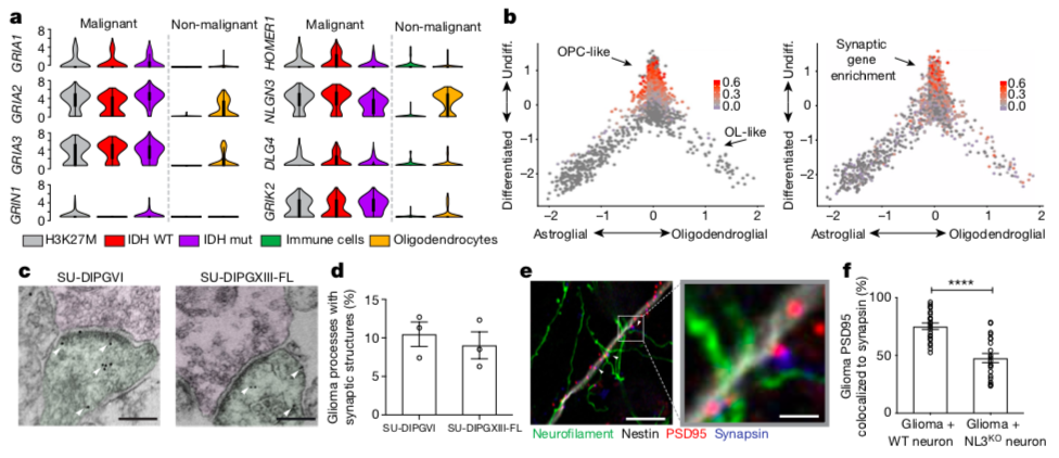 Figure 1: Evidence for functional synapses between neurons and brain tumor cells. In (a) we can see that the expression levels of synapse-related genes (GRIN1, GRIA1,2,3, GRIK2, DLG4, NLGN3, HOMER1) are highly enriched in malignant vs. non-malignant tissues from cancer patient samples. In (b) the data are arranged to see the lineage (x axis) and stemness (y axis) of cells from primary patient samples. In (c) we can see physical signs of synapses using electron microscopy in a human (left) and mouse (right) brain tumor. In (e) and (f) the researchers found signs of synaptic transmission in glioma by labeling the protein post-synaptic density-95 (PSD-95) and synapsin. (Credit: Venkatesh et al., 2019).