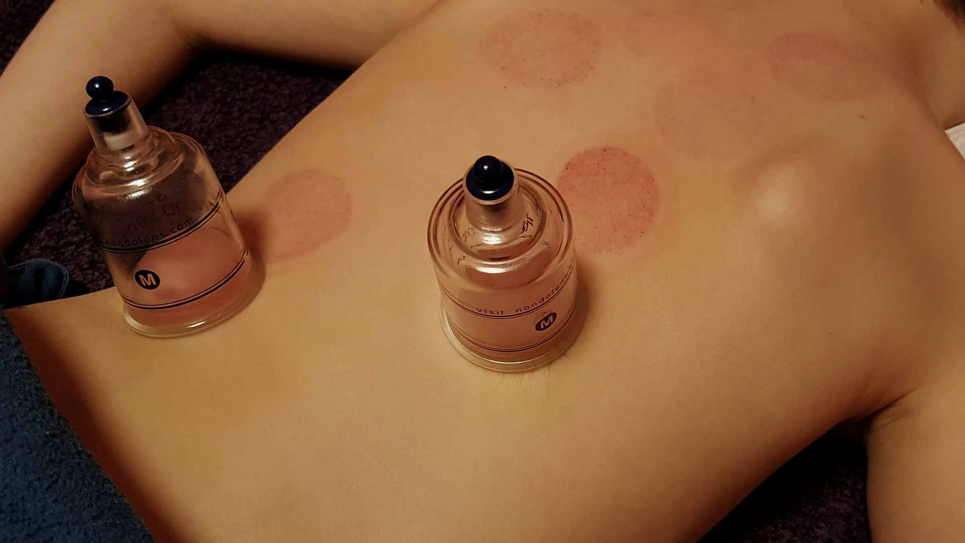 cupping-3310182_1920.jpg