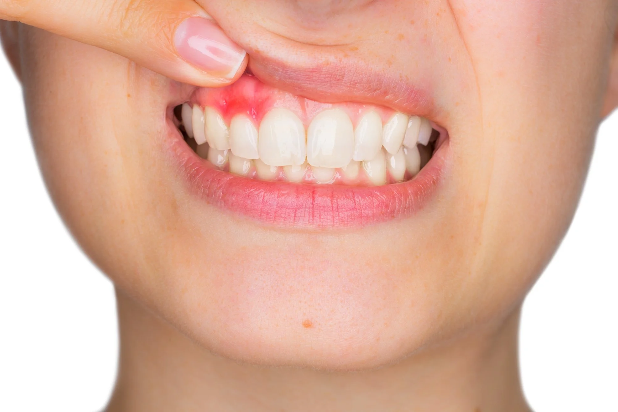 A lady with sore, tender, bleeding gums in need of dental hygiene appointment