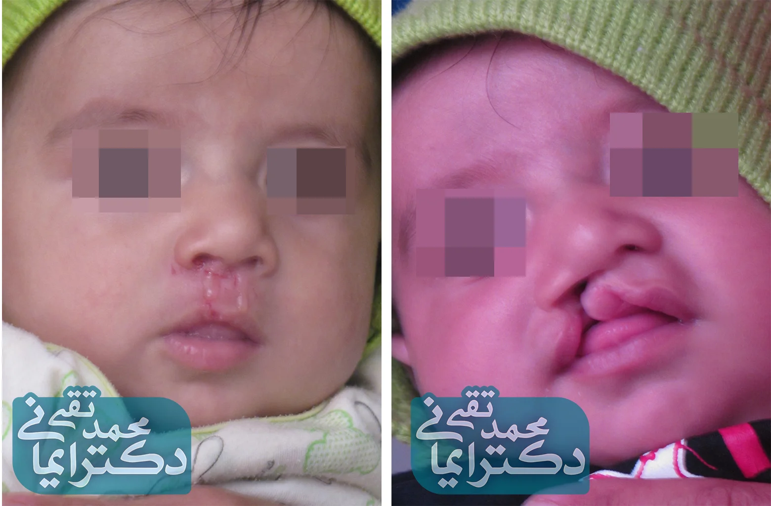 cleft_lip_1.jpg