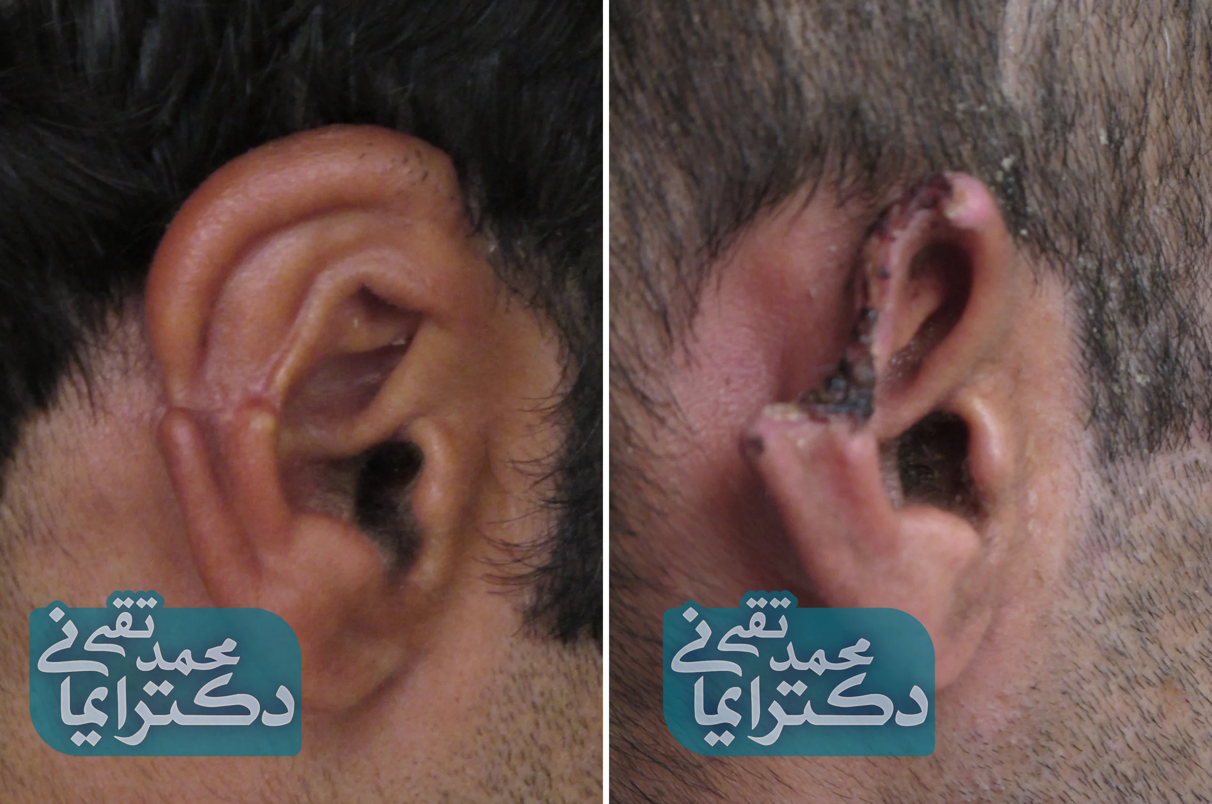 ear_reconstruction_01.jpg
