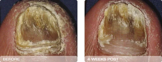 before_after_4weeks.jpg