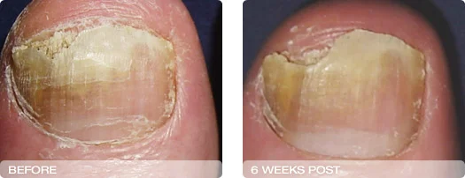 before_after_6weeks.jpg