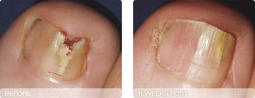 before_after_11weeks2.jpg