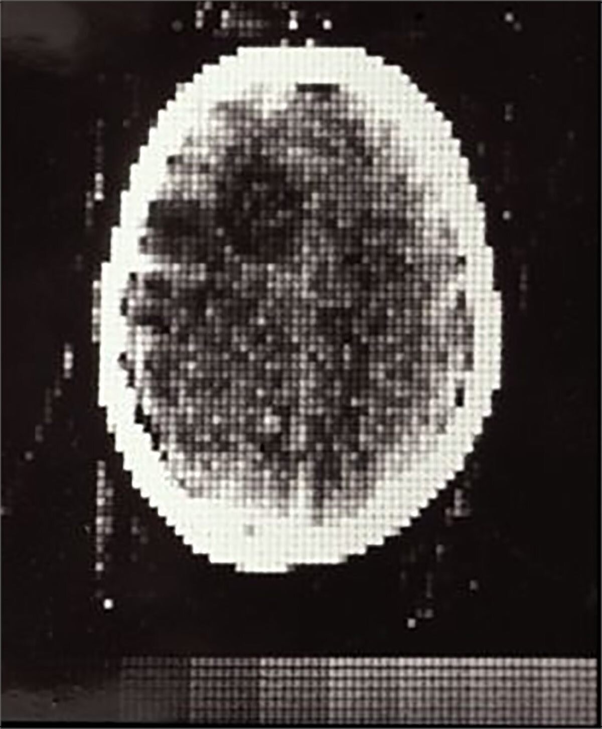 This week marked the 49th anniversary of the very first CT Head. 

The first CT scanner was built by Godfrey Hounsfield in 1971. It was designed to only take pictures of the brain, and revealed a brain tumour in a 41-year-old female patient. #histmed