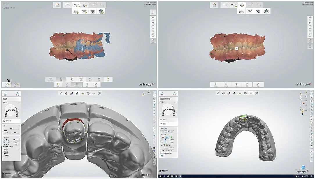 AI for Dental Labs: Changing the Game in Prosthetics